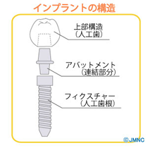 インプラントの構造