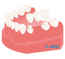 ブリッジ･入れ歯･インプラントの特徴　図