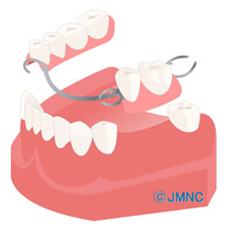 入れ歯　図
