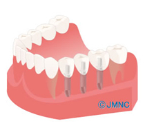 インプラント　図