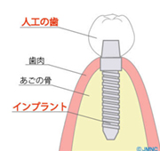 人工歯の取り付け　図