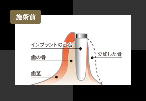 再生治療ビフォーアフターイメージ